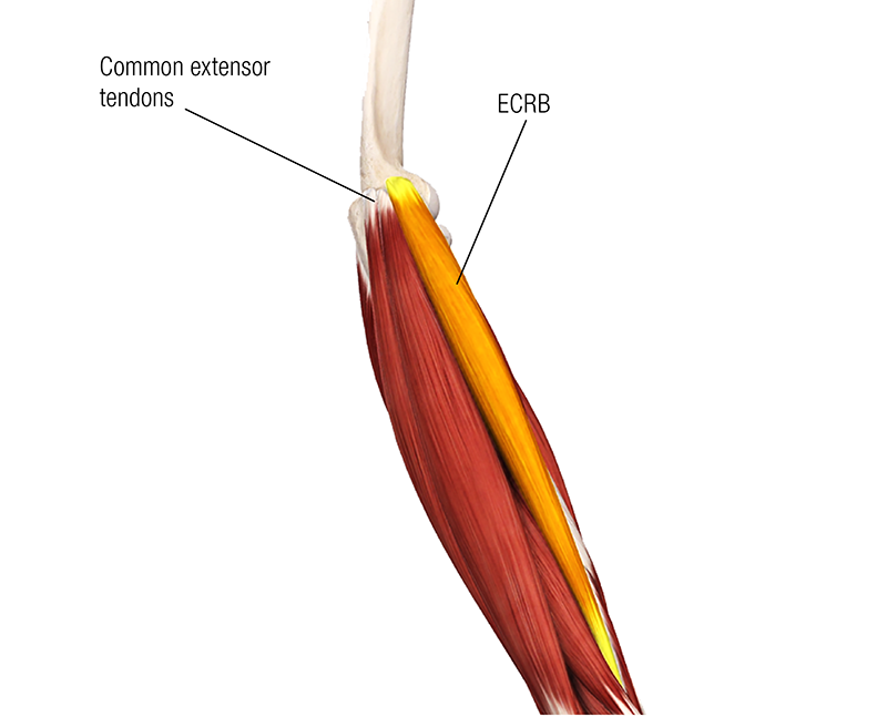 SO19_Current Views on Lateral Epicondylitis